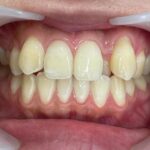インビザライン治療　症例