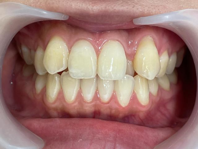 インビザライン治療 症例