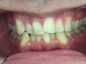 インビザライン治療　症例