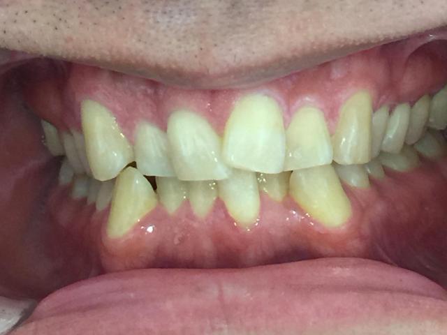 インビザライン治療　症例