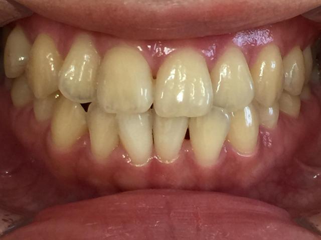 インビザライン治療　症例