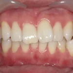 ホワイトニング　症例