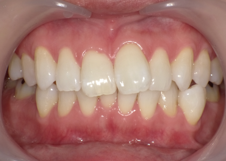 ホワイトニング 症例